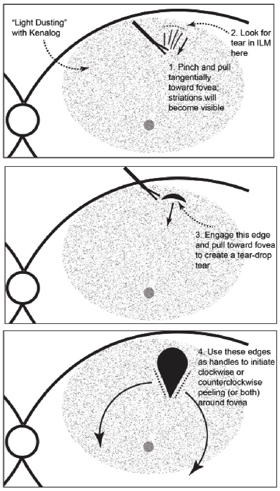 Key steps for peeling internal limiting membrane with Kenalog. Apply a light dusting of Kenalog on the macular surface (1:4 dilution in balanced salt solution). 1. Pinch a distal part of the ILM and pull it toward the fovea tangential to the retinal surface, identifying the tension lines from your instrument. 2. Look for a small rip in the ILM behind the tension line. 3. Release the forceps, grab the newly created torn edge of ILM (this step reduces the risk of pulling at the nerve fiber layer) and pull toward the fovea to create a teardrop-shaped window. 4. Use the lateral edges of the teardrop to serve as handles for extending wide flaps around the entire macular center. 
