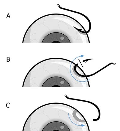 Advance-and-Cut for Fishhook Removal