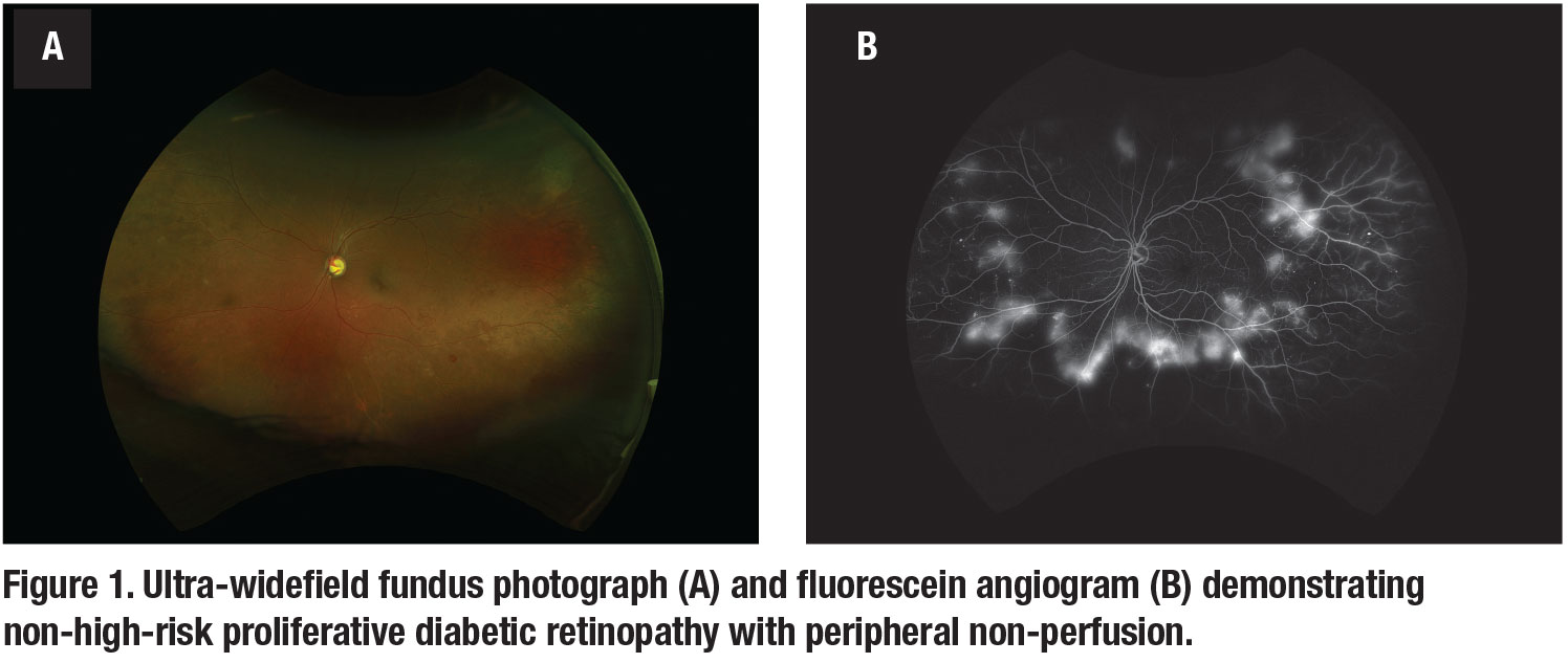 Ultra-wide-field fundus photographs and ultra-wide-field