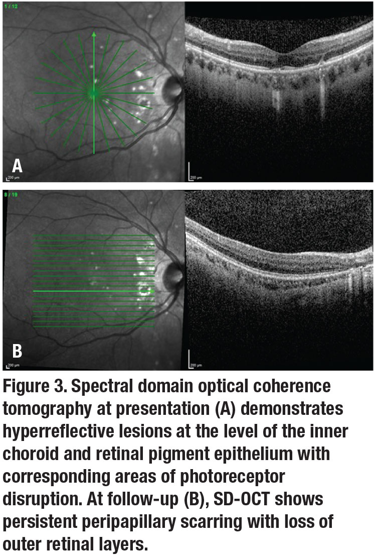 Full-Thickness Macular Hole