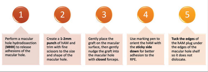 Figure 1. The five key steps in our approach to macular hole repair with human amniotic membrane.