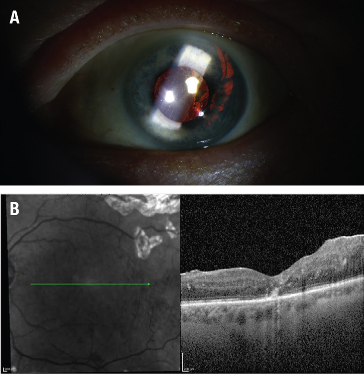 Slit-lamp photographs of anterior segment before neodymium: YAG laser... |  Download Scientific Diagram