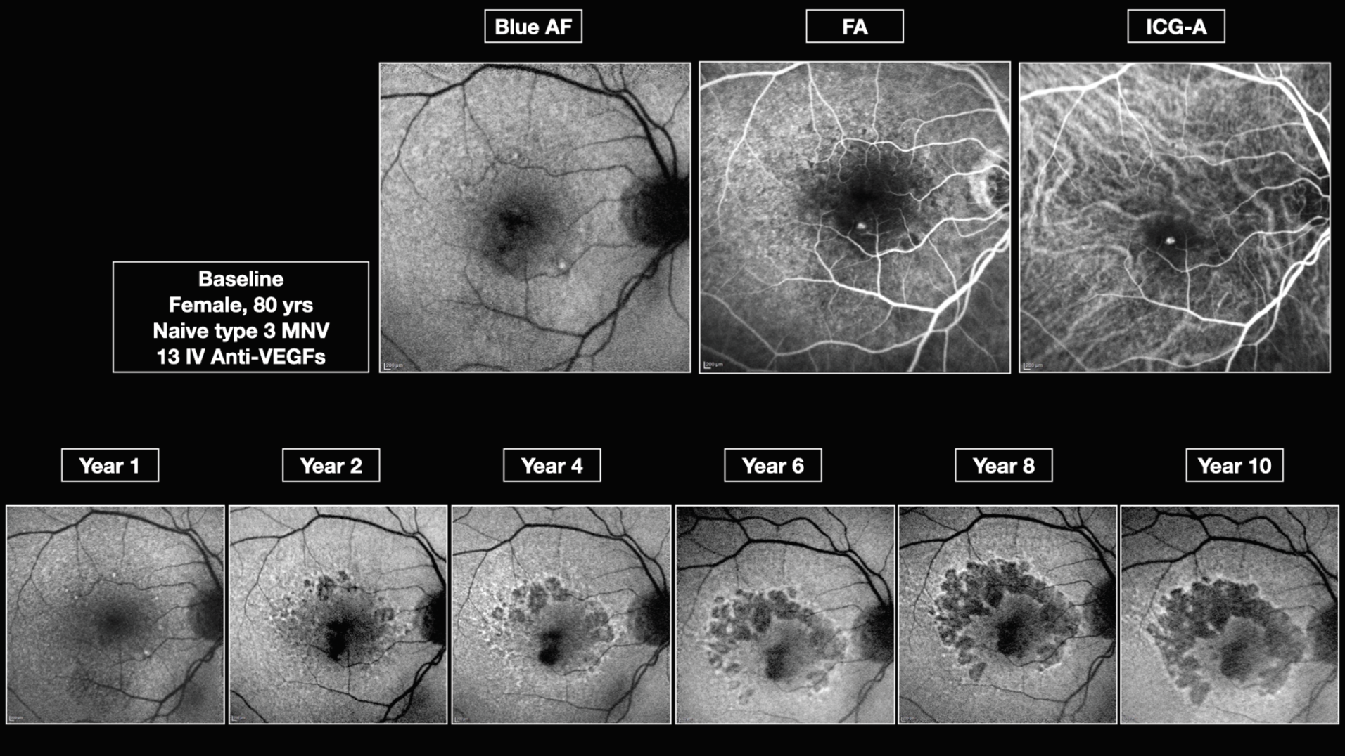 Figure 1: Multimodal imaging demonstrates the geographic atrophy progression over 10 years in an 80-year-old woman with type 3 neovascular membrane.