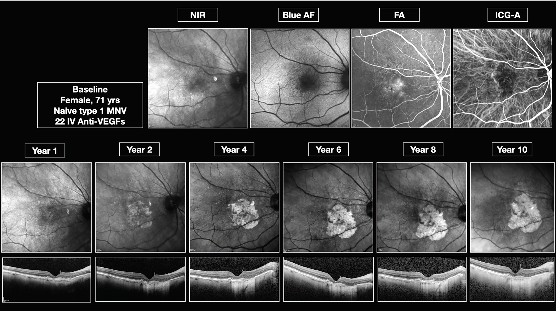 Figure 3. Type 1 choroidal neovascularization with geographic atrophy development over a 10-year period. 
